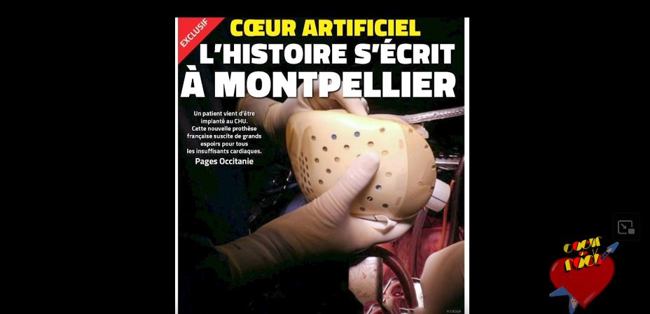 Image de couverture de presse annonçant la greffe de coeur artificiel réalisée à Montpellier